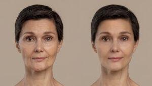 Botulino per le rughe del viso